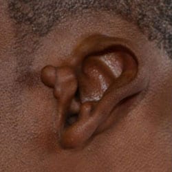 Ear Keloids / Lumps