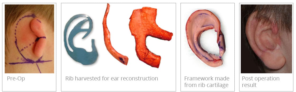 Microtia Ear Reconstruction 0352