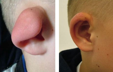 Other Ear Abnormalities