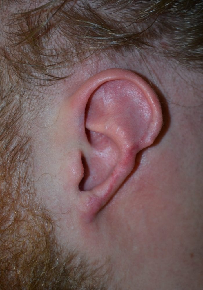 Before Traumatic Ear Loss