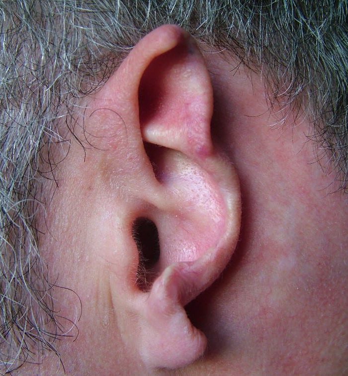 Before Traumatic Ear Loss