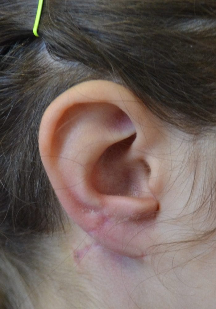 After Traumatic Ear Loss