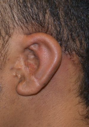 After Microtia After Operation