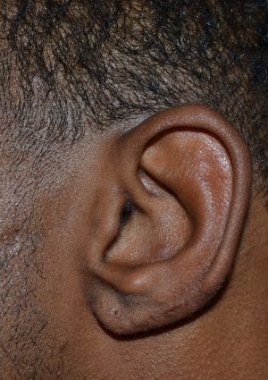 After Keloid