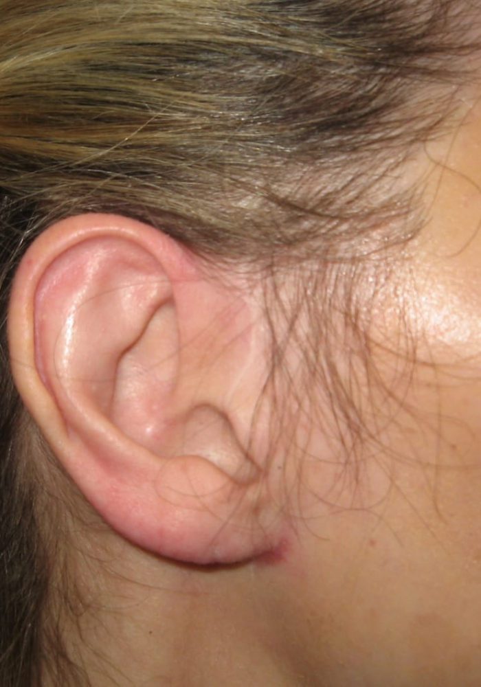 After Ear Lobe Reduction