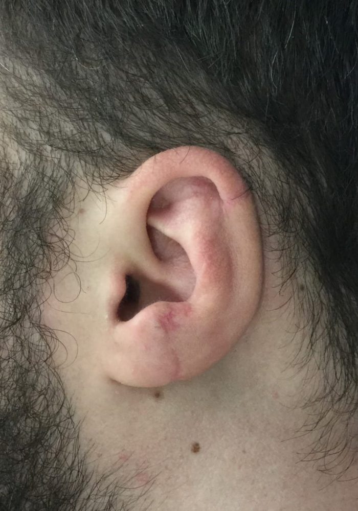 After Traumatic Ear Loss