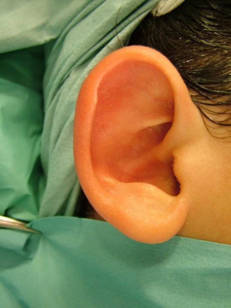 Earfold, ear-stitch and non-surgical ear pinning: key points