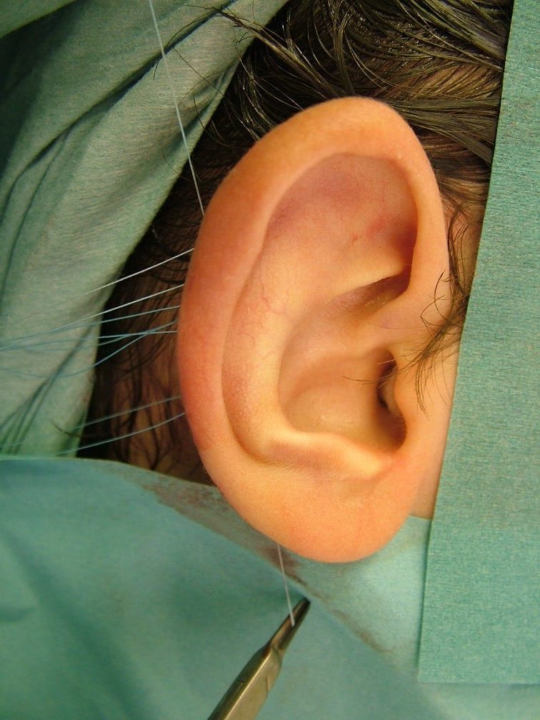 Earfold, ear-stitch and non-surgical ear pinning: key points