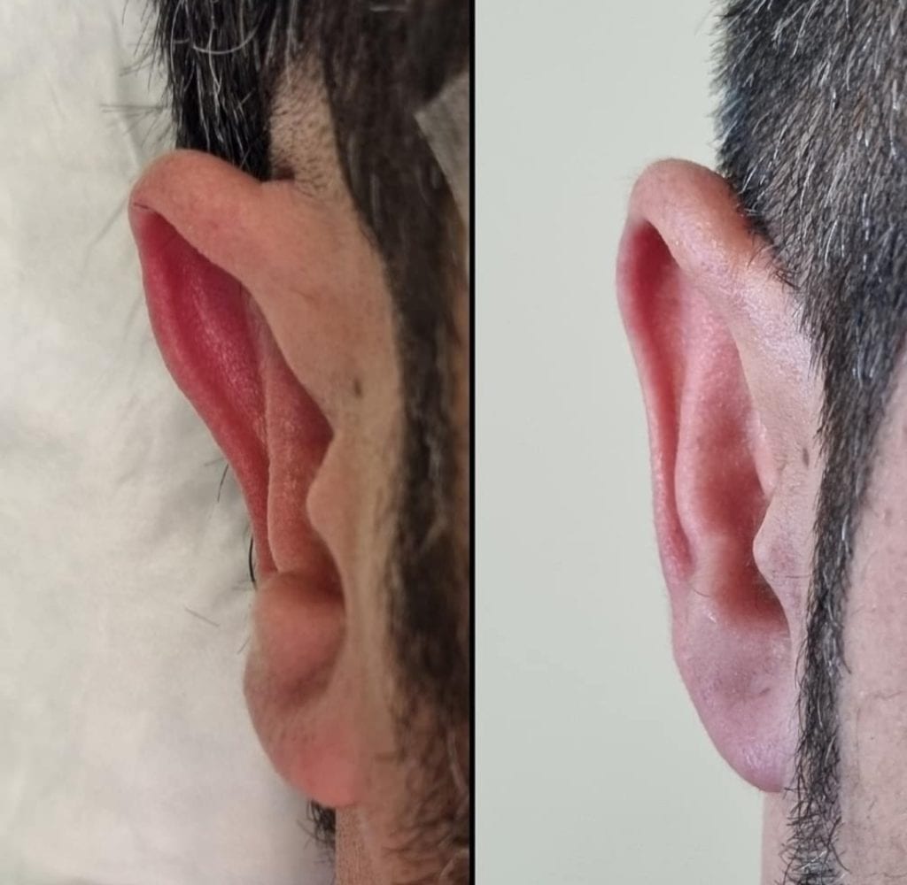 Earfold, ear-stitch and non-surgical ear pinning: key points