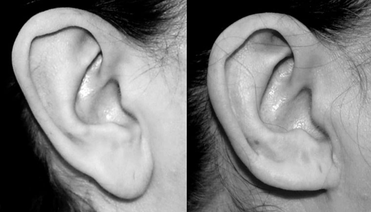 Ear Reduction – Macrotia Surgery: What is involved?